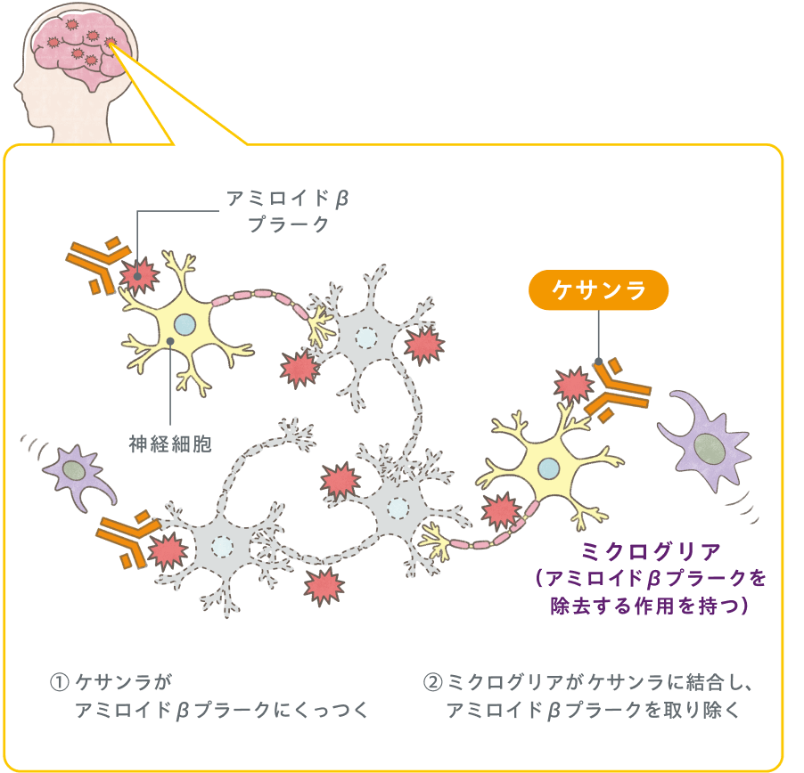 ケサンラは脳にたまったアミロイドβプラークを取り除くお薬です。