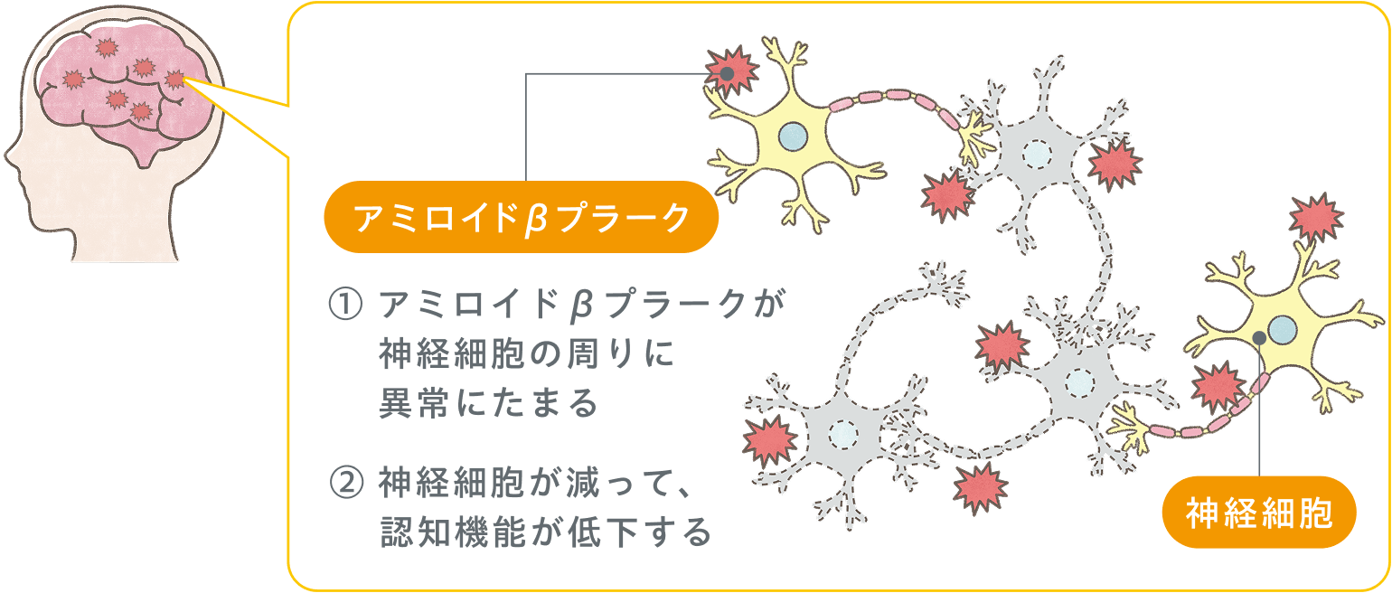 アルツハイマー病とは｜ケサンラ®による治療を受けられる患者さん向け